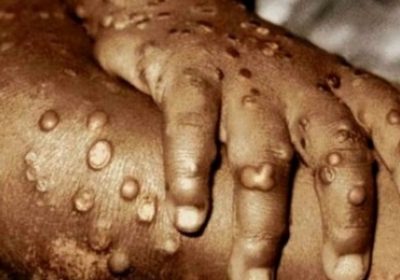 Lebih dari 80 Kasus “Cacar Monyet” Telah Dikonfirmasi Setidaknya di 12 Negara