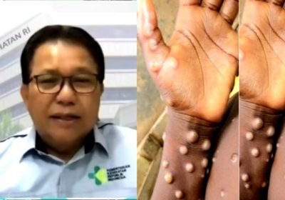 Kasus Cacar Monyet Pertama di Indonesia Terkonfirmasi, Warga Waspada