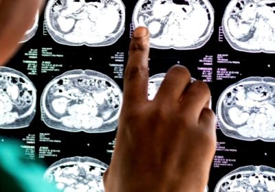 RS PON Hadirkan Layanan Unggulan Brain Check Up Deteksi Dini Stroke